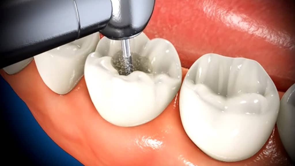 What To Expect When Getting A Root Canal Featured Image - Bowen Family Dentistry